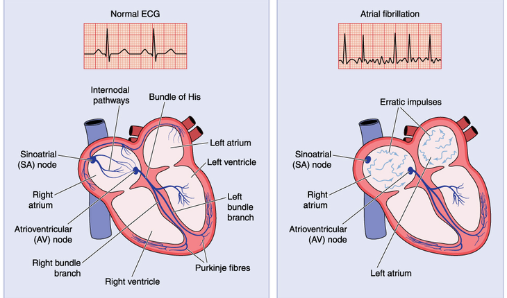 AFib