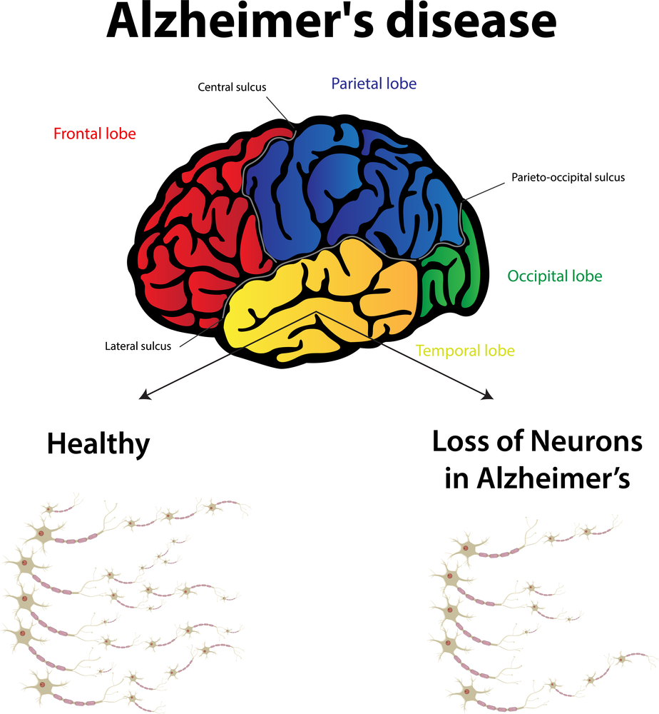 Alzheimer's.jpg