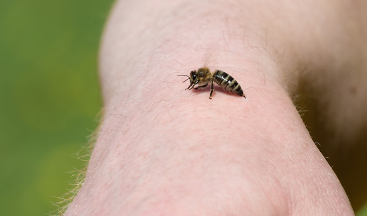 bee-sting