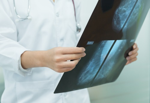 breast-cancer-mammogram-image