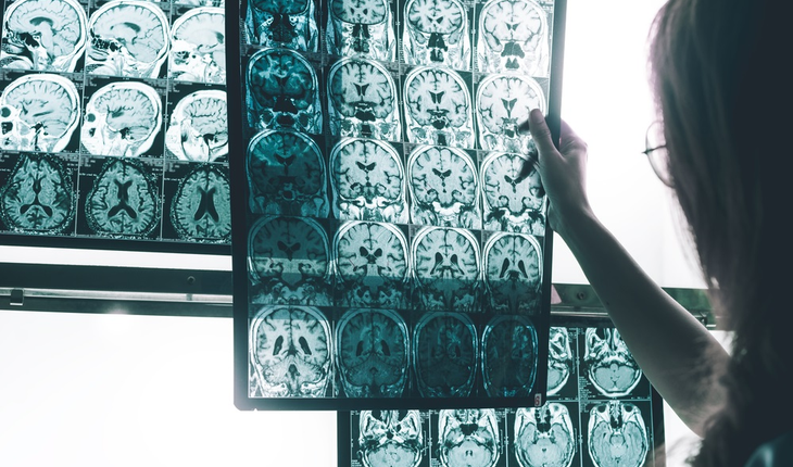 Dementia brain scan