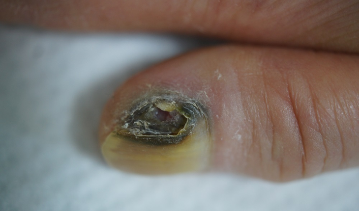melanoma-of-the-nail