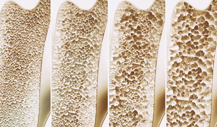 osteoporosis-bone-deterioration