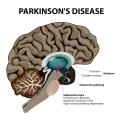 Parkinson's image resized_0