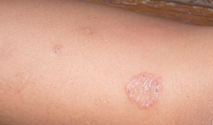 is-it-ringworm-signs-and-symptoms