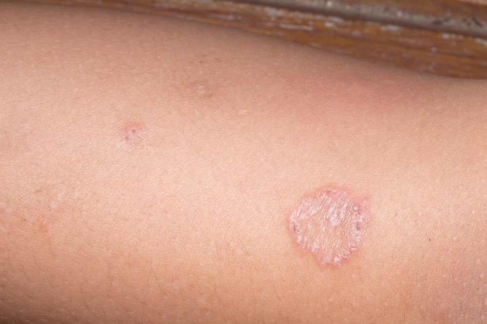 is-it-ringworm-signs-and-symptoms