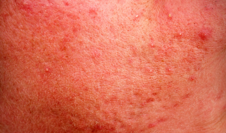 Rosacea skin