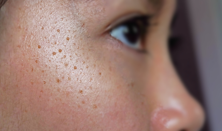 seborrheic-keratosis