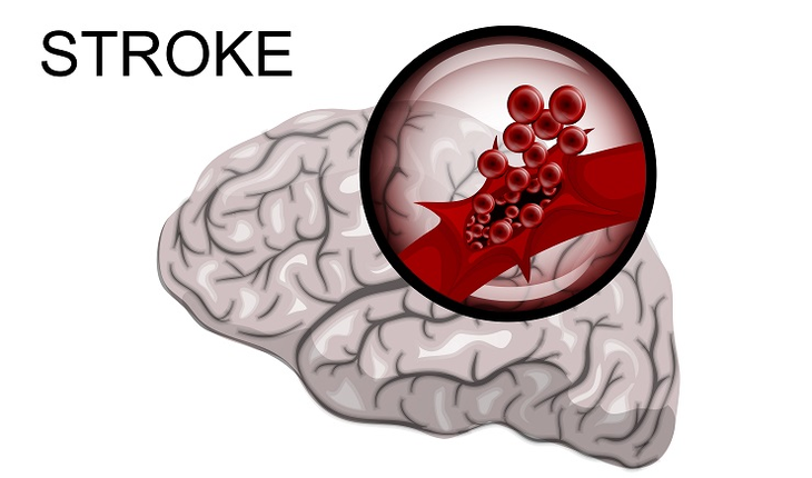 Stroke brain