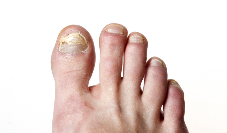 ToeNailFungus