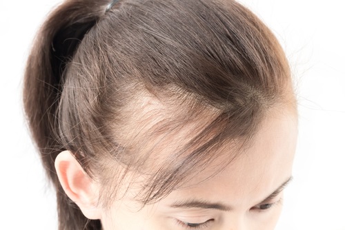Woman with hair loss
