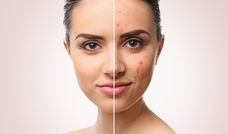 acne-treatment