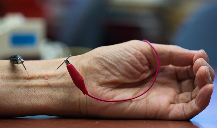 Acupuncture