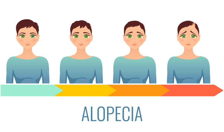 alopecia-hair-loss