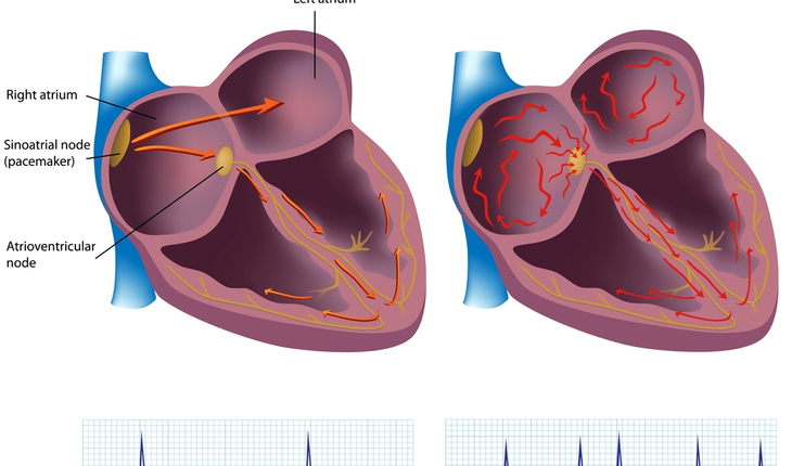 atrial fibrilation
