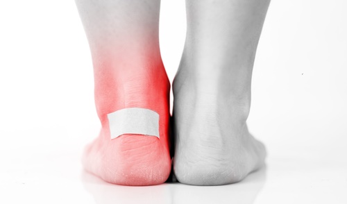 blister on foot