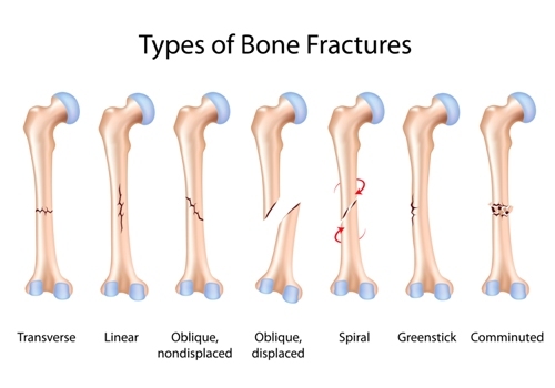 bone-fractures