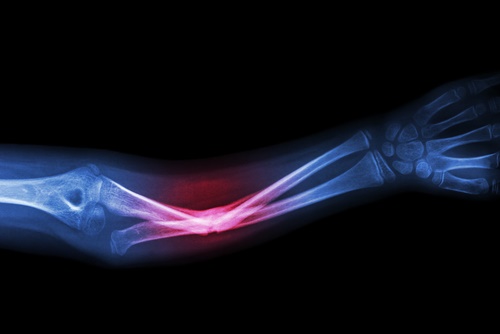 broken bone