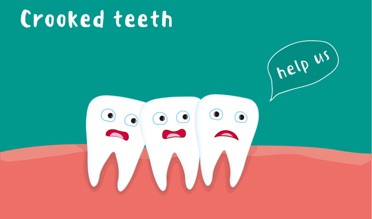 crooked teeth