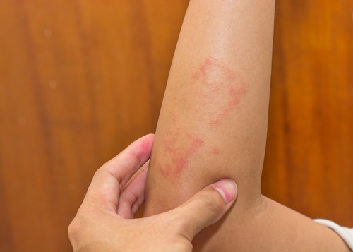 eczema itchy skin