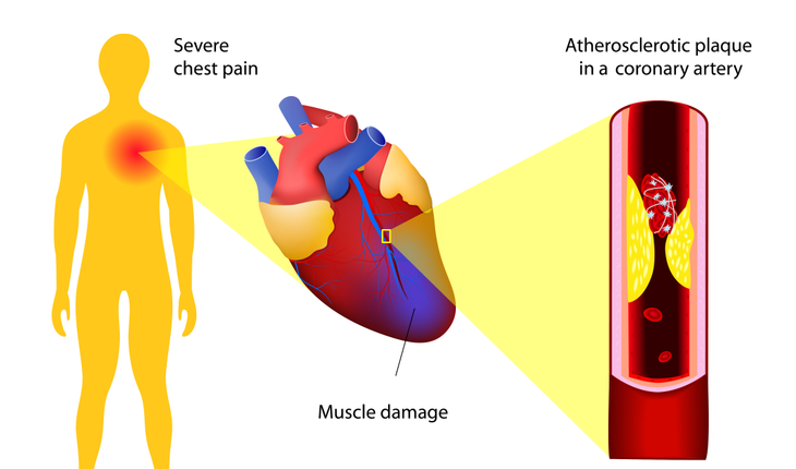 heart-attack