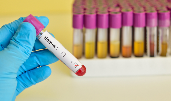 herpes virus