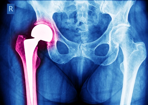 hip-diagram