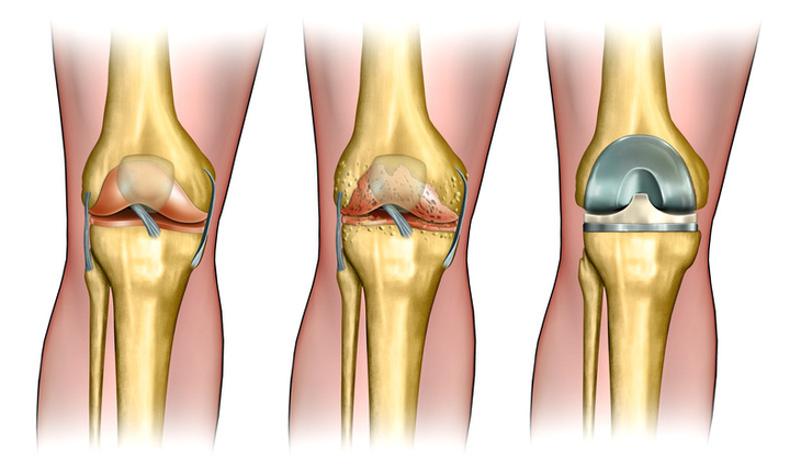 knee replacement