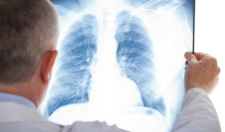 lung radiography