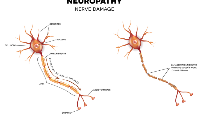nerve damage, neuropathy