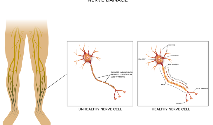 peripheral neuropathy