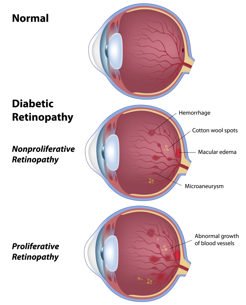 retinopathy.jpg