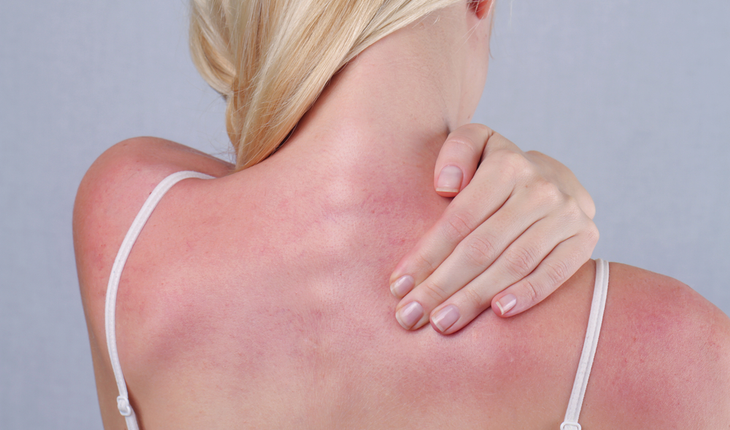sunburn