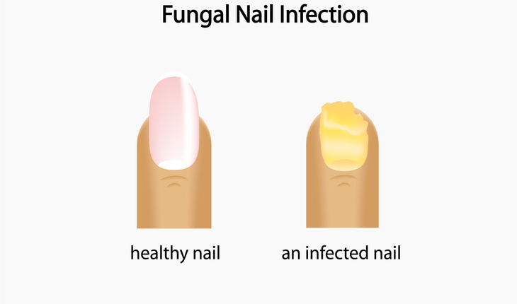 toenail fungus