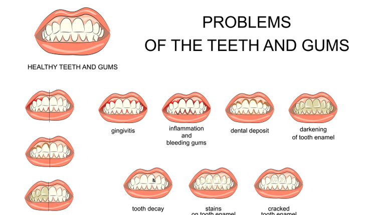 tooth-and-gum-problems