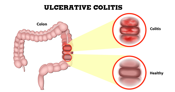 Ulcerative Colitis: Warning Signs, Diagnosis, Treatment And Remission 