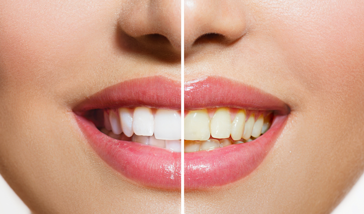 white-teeth