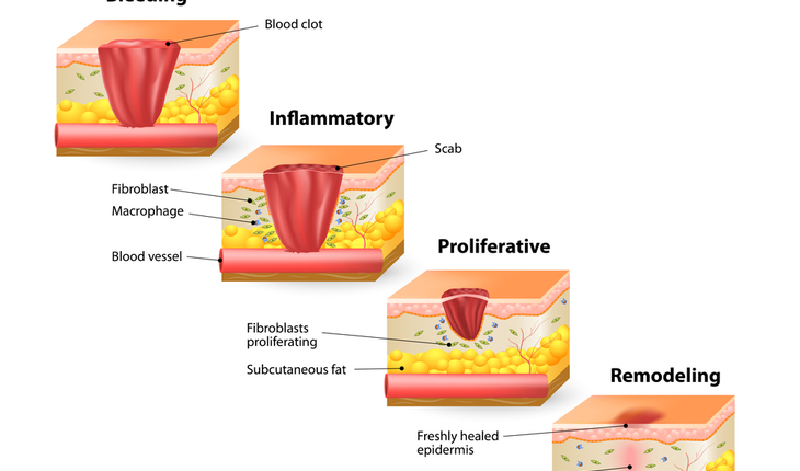 wound healing