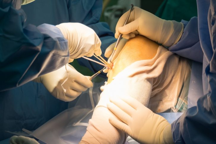 surgeons operating on shoulder
