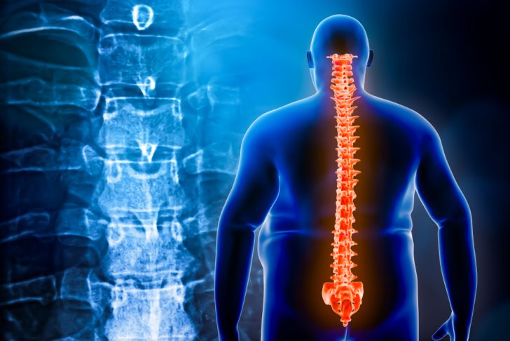 spine of obese man