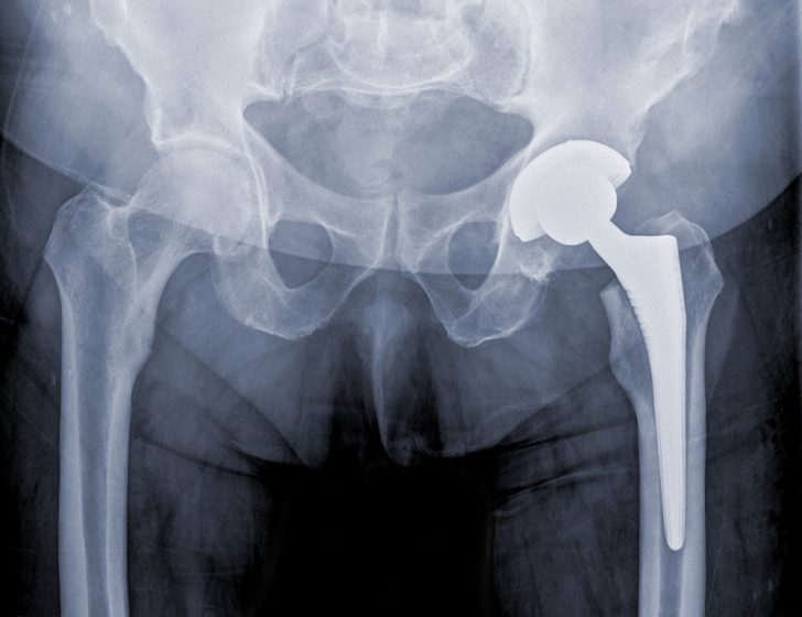 traditional, successful hip replacement