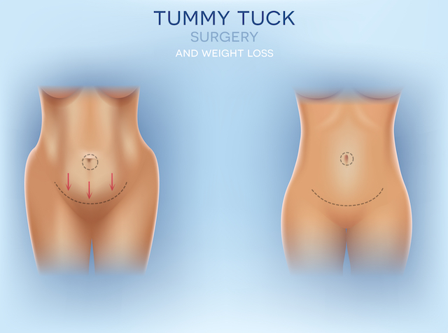 tummy tuck