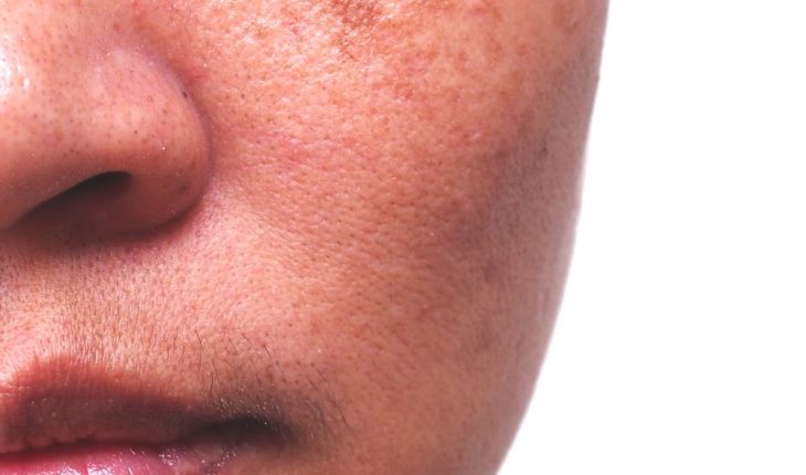 woman-with-acne