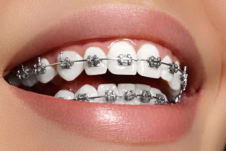 adult braces
