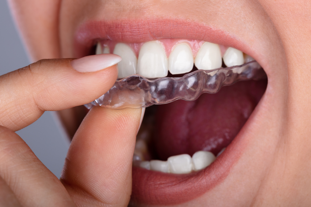 The Differences Between Invisalign and Invisible Braces - McCarthy