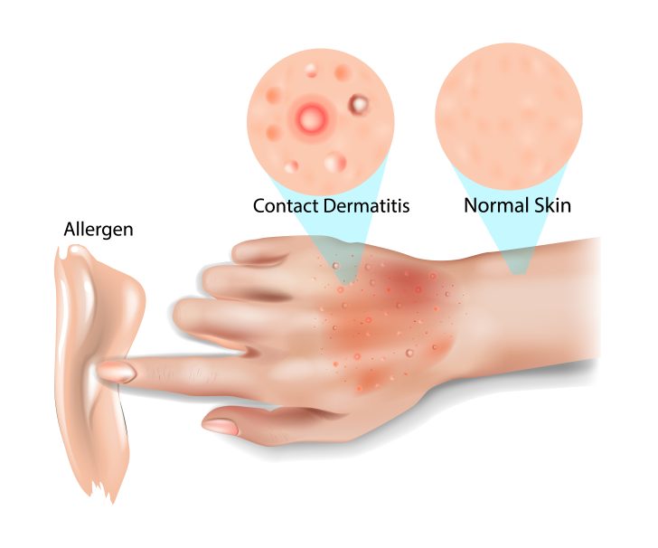 contact dermatitis