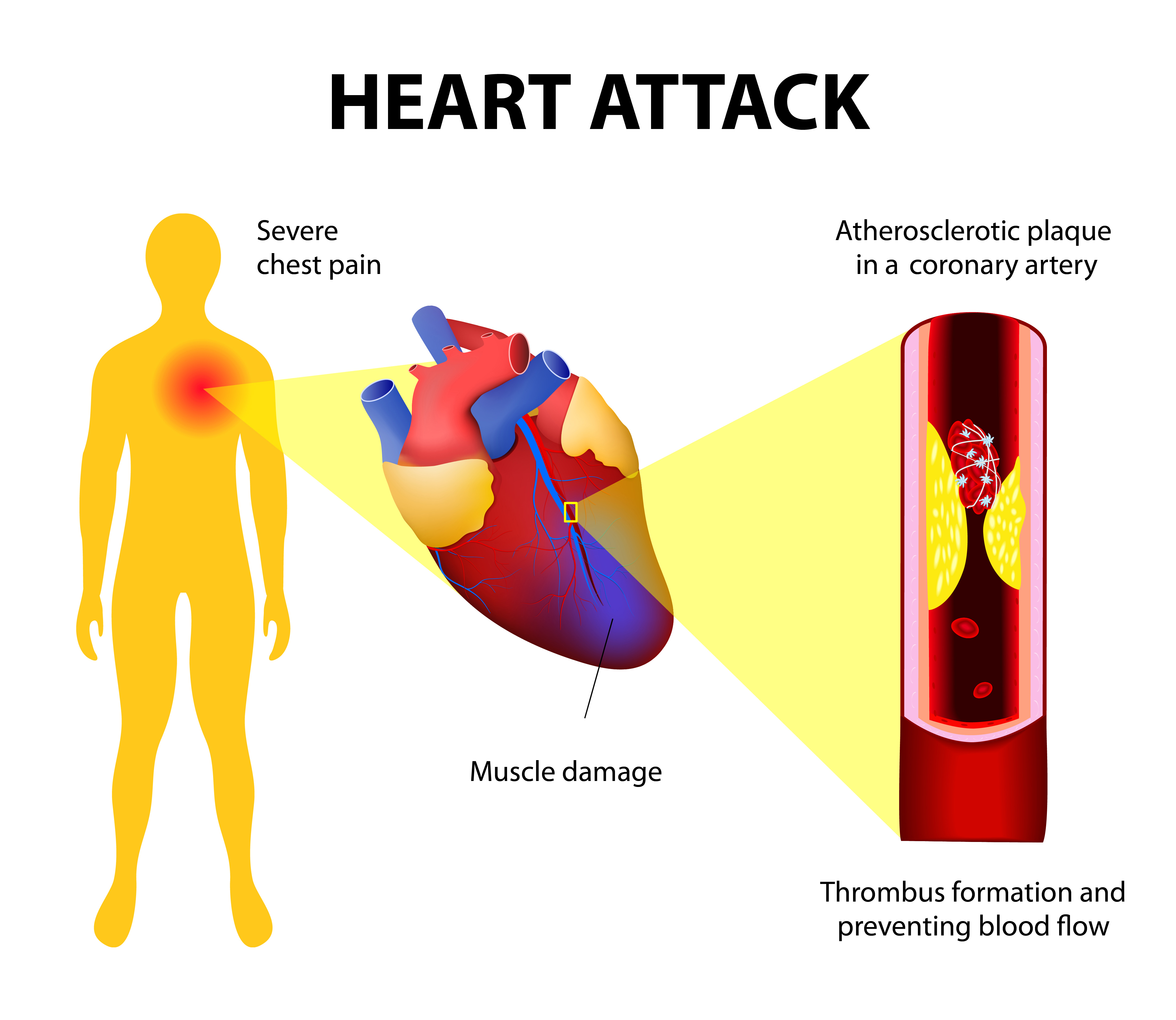 Ms Heart Attack