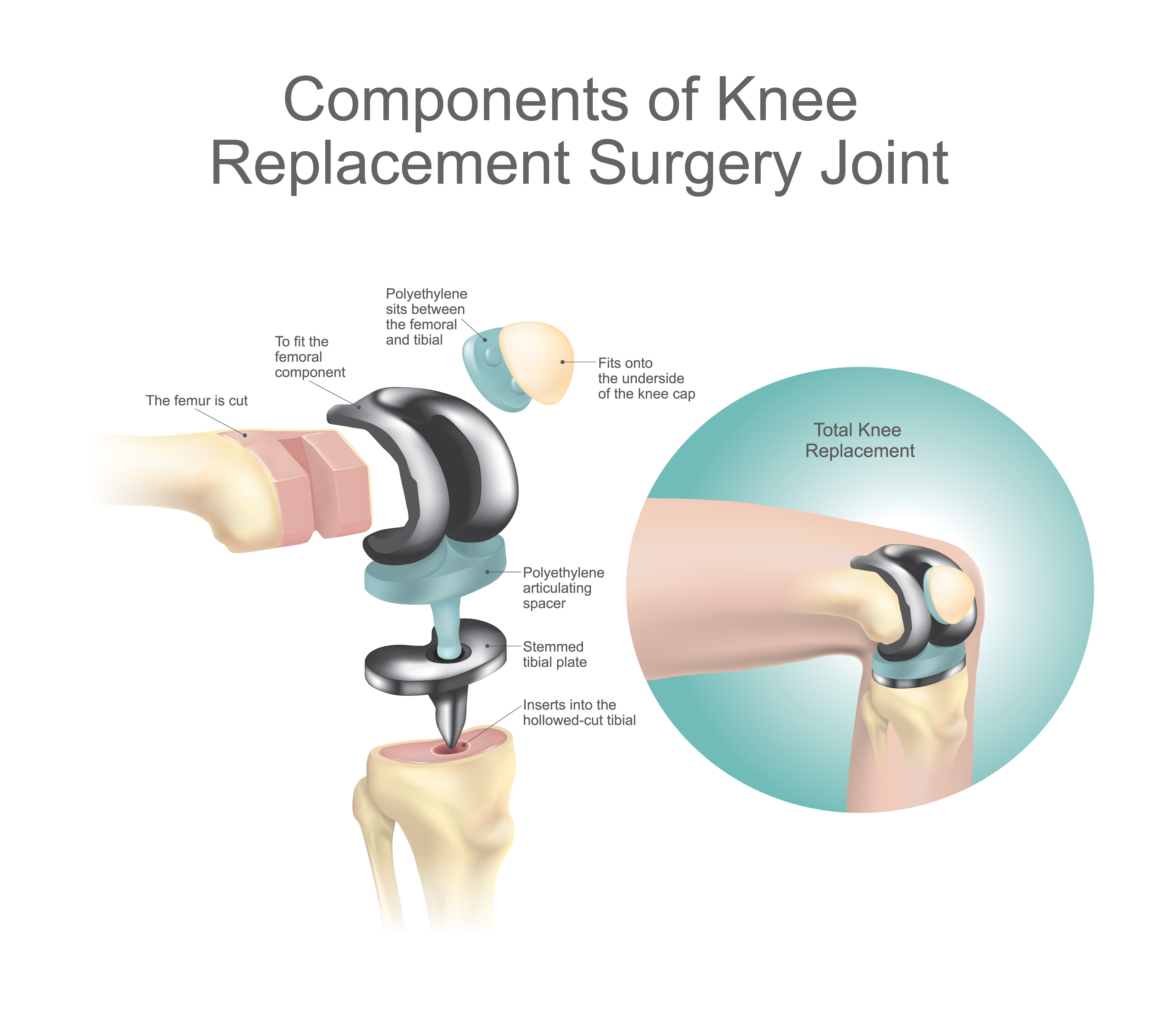 3-reasons-to-avoid-or-delay-knee-replacement-surgery-thirdage