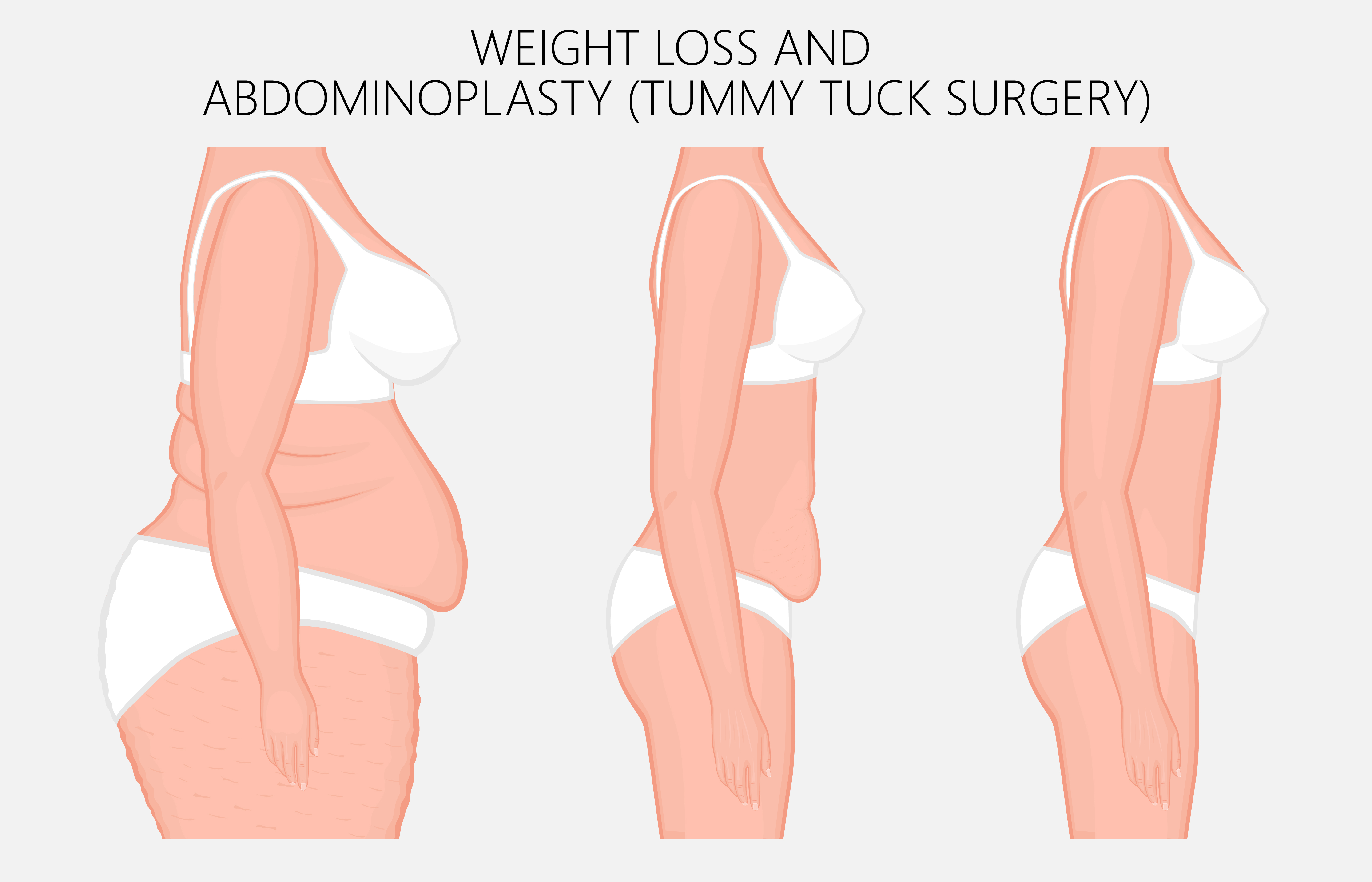 Options for Body Contouring after Bariatric Surgery thirdAGE