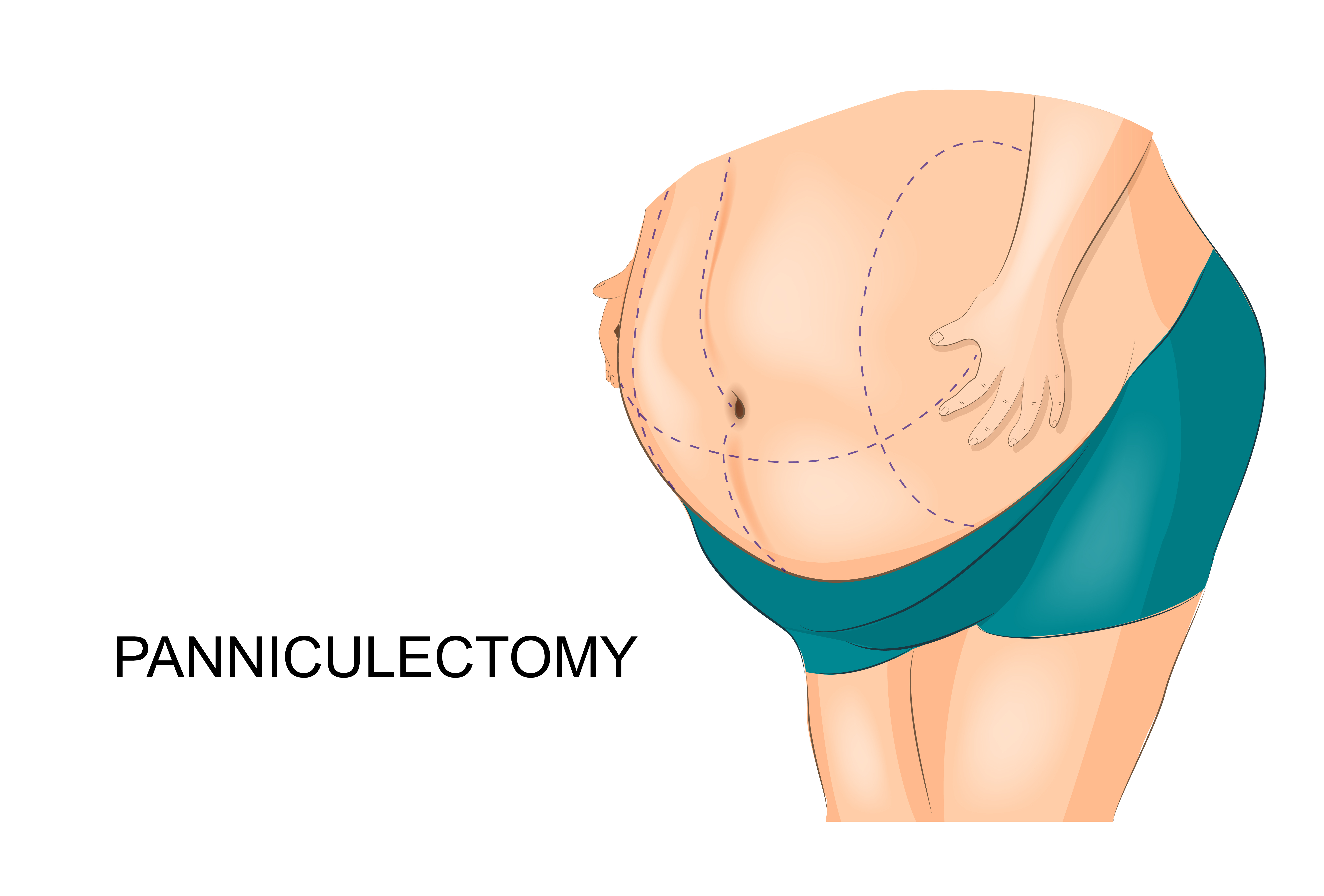 Options for Body Contouring after Bariatric Surgery thirdAGE